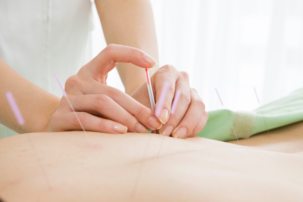 Woman sticks acupuncture into a back