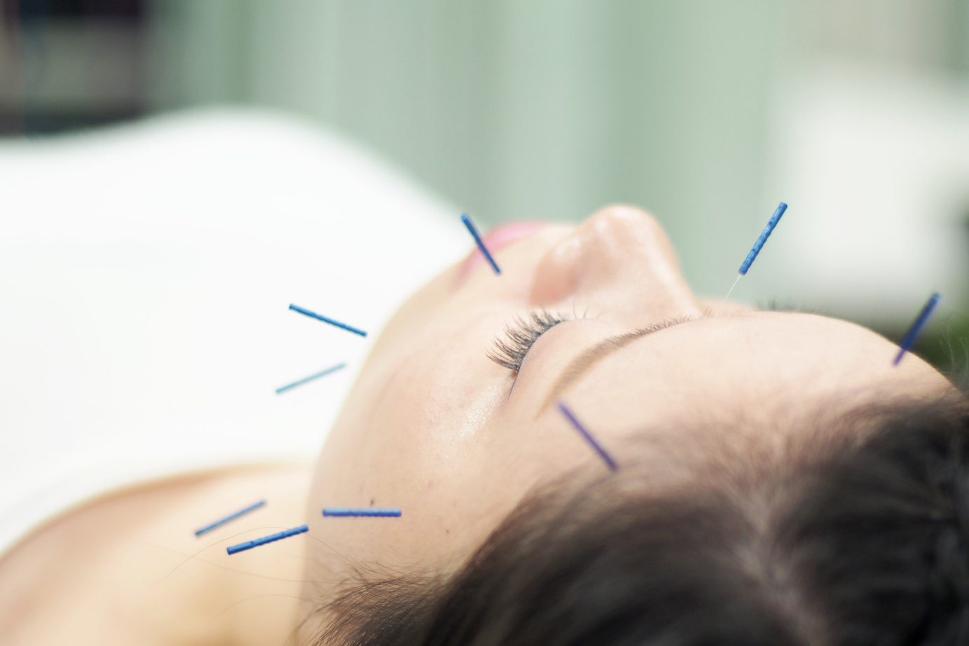 Woman receiving acupuncture on face